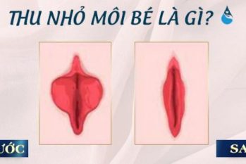 [Chị em nên tham khảo] 10+ Thông tin về thu nhỏ môi bé