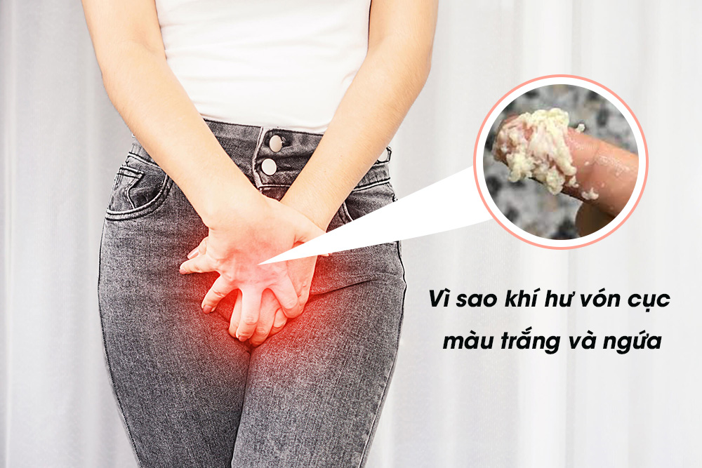 Vùng kín bị ngứa và có dịch trắng vón cục : Nguyên nhân + Cách chữa trị