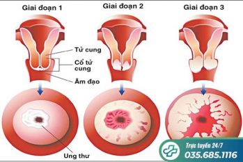 Tất tần tật dấu hiệu ung thư cổ tử cung không thể chủ quan