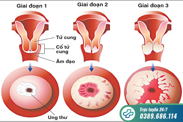 Tất tần tật dấu hiệu ung thư cổ tử cung không thể chủ quan