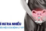 Khí hư ra nhiều là bị gì? Cách điều trị hiệu quả