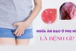 [Bác sĩ giải đáp]: Ngứa âm đạo là bị gì?