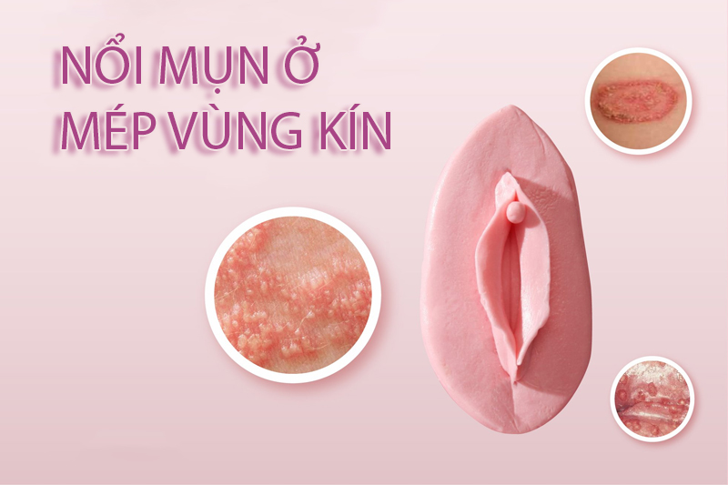 5+ Hình ảnh nổi mụn ở mép vùng kín nữ phổ biến