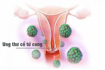 Ung thư cổ tử cung giai đoạn 1: Nguyên nhân, triệu chứng, nguy hại