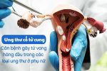 Dấu hiệu ung thư cổ tử cung giai đoạn 2 không thể xem nhẹ!