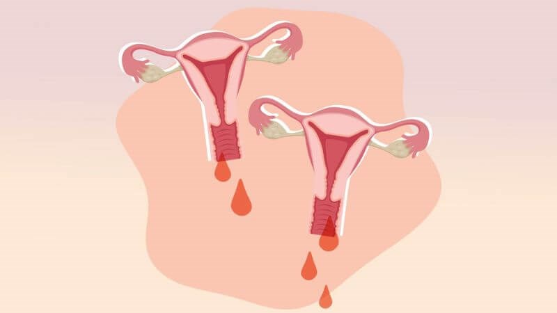 Nguyên Trưởng khoa phụ sản chia sẻ 5 nguyên nhân gây nên chảy máu vùng kín