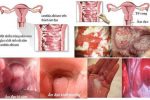 Tổng quan viêm âm đạo – Những điều cần biết và cách phòng tránh