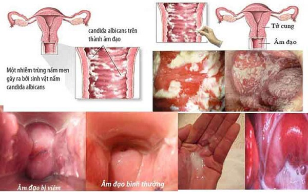 Tổng quan viêm âm đạo – Những điều cần biết và cách phòng tránh