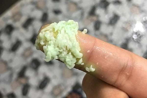 Khí hư màu xanh bã đậu là dấu hiệu bệnh gì? Chuyên gia cảnh báo & cách chữa an toàn