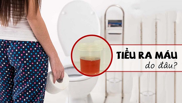 Đi tiểu ra máu là bệnh gì? Chuyên gia chỉ rõ 6 bệnh nguy hiểm cần chú ý