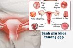 Các bệnh phụ khoa nữ giới thường gặp: Dấu hiệu nhận biết & Cách điều trị hiệu quả