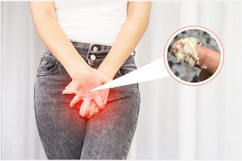 Âm đạo ra nhiều khí hư ngứa là bị gì? Cách khắc phục hiệu quả?