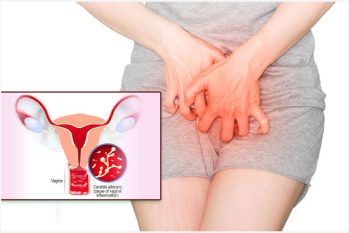 Nguyên nhân gây ngứa âm hộ, ngứa âm đạo thường gặp