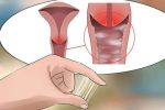 Dấu hiệu bị nhiễm trùng âm đạo và Cách khắc phục hiệu quả