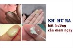 Nguyên nhân âm đạo ra dịch trắng nhiều bất thường và Cách xử lý hiệu quả