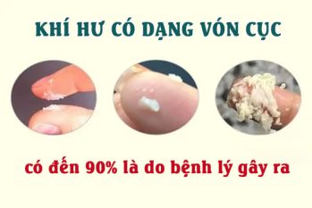 Khí hư vón cục là bị gì? Có nguy hiểm không