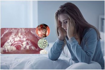 Âm đạo có vết trắng là bị gì? Để lâu có tự hết không?