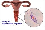 Viêm trùng roi âm đạo nữ, bệnh lý phụ không thể xem thường!