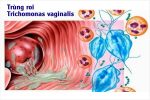 Nhiễm Trichomonas: Dấu hiệu, Nguyên nhân và Cách khắc phục hiệu quả